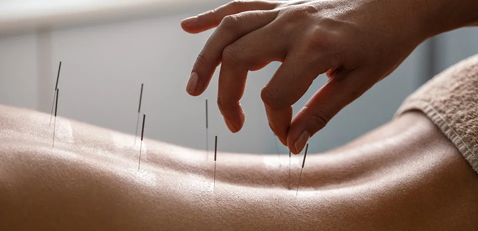 An acupunturist carefully placing needles along a patient's lower back